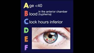 The ABCDEF Guide for Iris Nevus Growth to Melanoma by Carol Shields [upl. by Pratte]