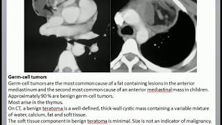 Anterior mediastinal mass [upl. by Pomfret]