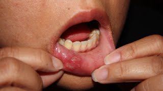 How to Get Rid of Canker Sores Home Remedies [upl. by Kcinimod]