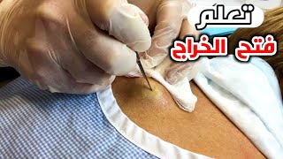 اتعلم فتح الخراج في المنزل او المستشفيLearn the correct way to open an abscess [upl. by Arand]