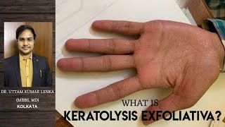 Keratolysis ExfoliativaRepeated peeling of skin from palm and sole Hath aur paw se Chamdi Nikalna [upl. by Essirehc]