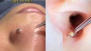 Ultimate Pimple Popping Compilation 2024 Satisfying Cyst amp Blackhead Removal [upl. by Azeel]