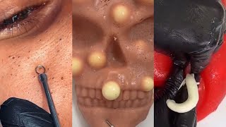 74 Minutes Of Top ASMR Pimple Popping Video [upl. by Falito]