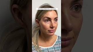 Trifecta Lift amp Duplex Combination Treatment with Dr Kami Parsa [upl. by Nithsa]