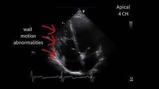 A special cardiomyopathy [upl. by Nottnerb]