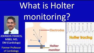 What is Holter monitoring [upl. by Rutter]