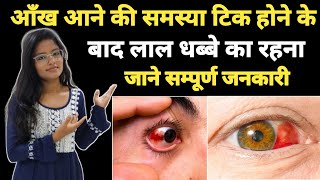 Sub Cunjuctiva👁️ Hemorrhage Red Spot Eye  Ankha Aane Ke Bad Ankho Me Lal Dhabe Ka Rahana [upl. by Erline]