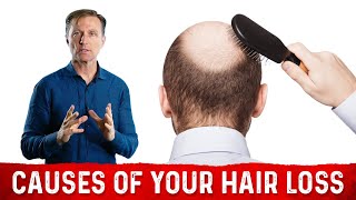 The Underlying Root Cause Of Hair Loss – Treatment For Hair Loss Dr Berg [upl. by Anol]