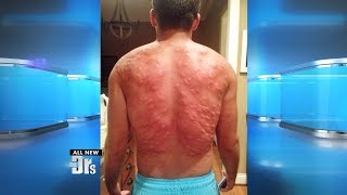 Man Suffers Worst Mosquito Attack Ever [upl. by Irol]