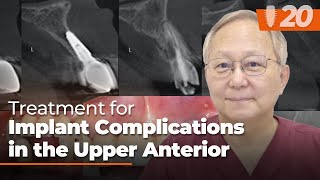 Treatment for Implant Complications in the Upper Anteriorㅣ Soft Tissue Grafting [upl. by Ackley]