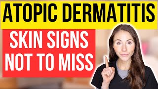 Dont Miss These 15 Signs Of Atopic Dermatitis [upl. by Baler]