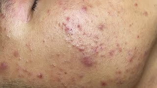 ACNE TREATMENT VU QUYNH MI Acne On Boys Cheek 2024 [upl. by Elolcin]