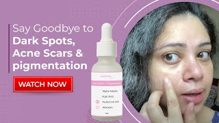 सालो पुराने Dark Spots Pigmentation Acne Scars हुए साफ़  100 effective Face serum  Honest Review [upl. by Irabaj980]