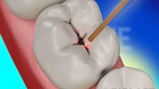 Dental Restoration with Waterlase Laser Dentistry  BIOLASE [upl. by Shirberg903]