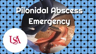 Pilonidal Abscess Emergency Incision amp Drainage [upl. by Alam]