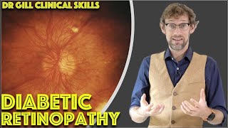 How To Use An Ophthalmoscope To Check For Diabetic Retinopathy  Dr Gill [upl. by Naivaj62]