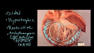 What is Cardiomyopathy [upl. by Neyuq]