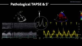 〖Echocardiography〗 Pathological S amp TAPSE [upl. by Airot]