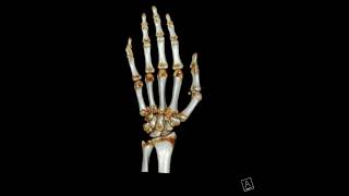 4th and 5th Metacarpal base fracture [upl. by Nirtiak965]