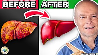 1 Absolute Best FATTY LIVER DETOX [upl. by Ailem]