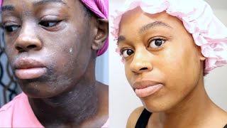 Eczema Treatment Journey  This Skincare Routine Changed My Life  DeSade [upl. by Willa308]