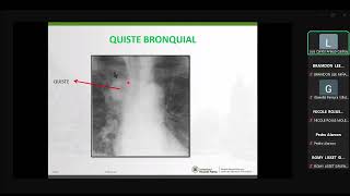 PATOLOGÍA PULMONAR  Radiologia [upl. by Sigvard465]