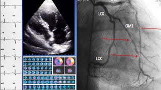 A case of ischemic cardiomyopathy ECG echo SPECT coronary angiography and treatment [upl. by Lewis]