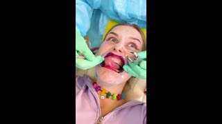 Ho messo delle facciate dentali finte per il dentista 😂 scherzo [upl. by Klara37]