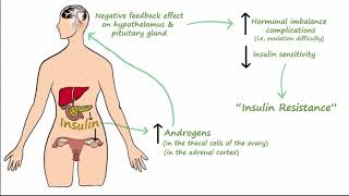 Polycystic Ovarian Syndrome PCOS  Pathophysiology Symptoms Treatment [upl. by Adnotal]