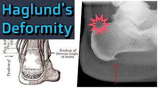 Haglunds Deformity [upl. by Haneeja]