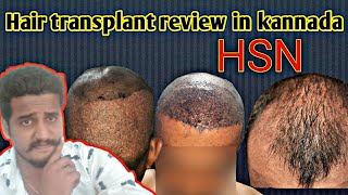 Hair transplant in kannada  HSN Bangalore [upl. by Kudva]