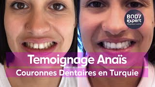 SOINS DENTAIRES  🦷 Témoignage Anaïs  20 couronnes dentaires Emax  BODYEXPERT [upl. by Eaner]