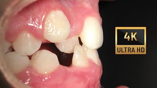 Class III and Crossbite stability after 8 years [upl. by Hsivat568]