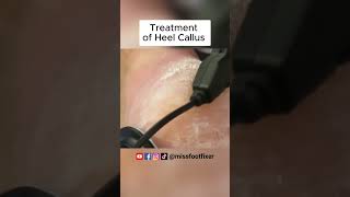 Heel Callus Scraping Using Electric File Compelete Procedure by Famous Podiatrist Miss Foot Fixer [upl. by Dela40]