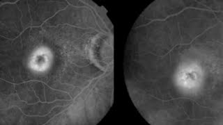 FFA CLASSIFICATION OF CNVM Choroidal neovascular membrane  Occult vs Classic CNVM [upl. by Moonier]