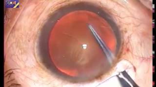 SMALL INCISION Cataract Extraction  SICS  Dr Samar Basak [upl. by Uzzia678]