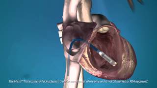 The Medtronic Micra—the Worlds Smallest Pacemaker Is Implanted in the Heart [upl. by Mcgean]