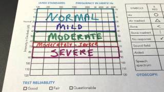 How to Read Your Audiogram [upl. by Eleph551]