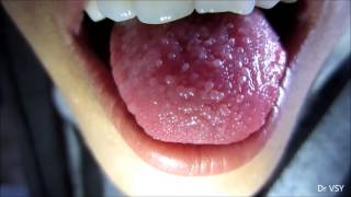 Papillitis Tongue [upl. by Eimoan]