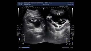 Ureterovesical junction UVJ obstruction with two ureteric stones [upl. by Yorgo]