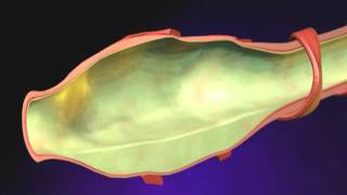 Bronchiectasis Animation  What is Bronchiectasis Videomp4 [upl. by Loats311]