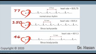 Sinus arrhythmia  tachycardia bradycardia and respiratory arrhythmia [upl. by Oz448]