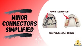 Minor Connectors  Removable Partial Denture RPD [upl. by Alyn]