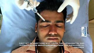 Regional Nerve Block for Scalp  Local Anaesthesia for PRP amp other scalp procedures [upl. by Obaza325]