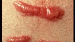 DermTV  How to Treat a Keloid Scar DermTVcom Epi 279 [upl. by Demona309]