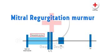 Mitral regurgitation murmur [upl. by Haidabo]