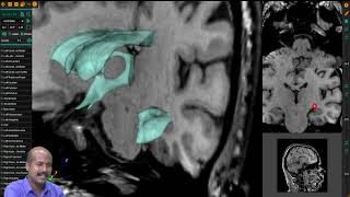 Understanding the Lateral Ventricles in Neuroanatomy  Brain Structures Explained [upl. by Lleynod110]