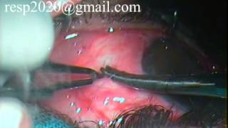 Conjunctival Graft Suturing For Pterygium Excision With Autograft By Dr Sudhir Singh 33 [upl. by Omolhs769]