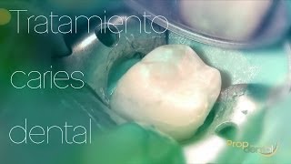 Tratamiento caries dental [upl. by Emoraj]