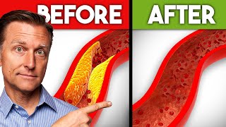 Best Nutrients to Remove Plaque from Arteries [upl. by Monty]